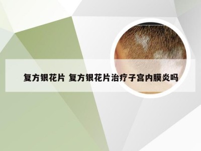 复方银花片 复方银花片治疗子宫内膜炎吗