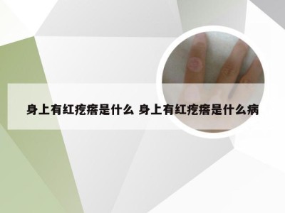 身上有红疙瘩是什么 身上有红疙瘩是什么病