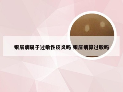 银屑病属于过敏性皮炎吗 银屑病算过敏吗