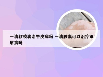 一清软胶囊治牛皮癣吗 一清胶囊可以治疗银屑病吗