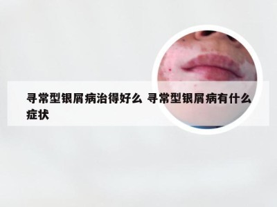 寻常型银屑病治得好么 寻常型银屑病有什么症状