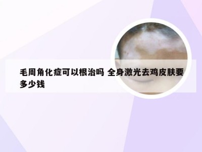 毛周角化症可以根治吗 全身激光去鸡皮肤要多少钱