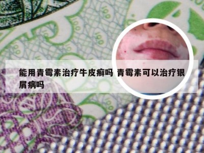 能用青霉素治疗牛皮癣吗 青霉素可以治疗银屑病吗