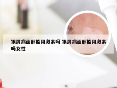 银屑病面部能用激素吗 银屑病面部能用激素吗女性