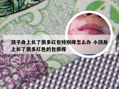 孩子身上长了很多红包特别痒怎么办 小孩身上长了很多红色的包很痒