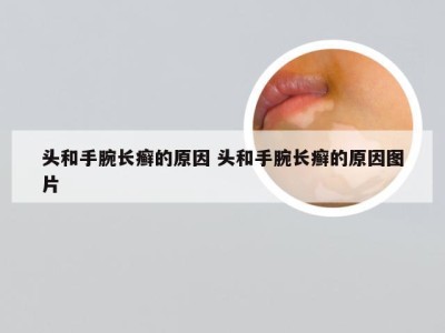 头和手腕长癣的原因 头和手腕长癣的原因图片