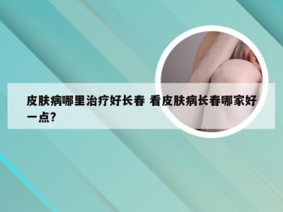 皮肤病哪里治疗好长春 看皮肤病长春哪家好一点?