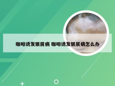 咖啡诱发银屑病 咖啡诱发银屑病怎么办