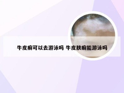 牛皮癣可以去游泳吗 牛皮肤癣能游泳吗