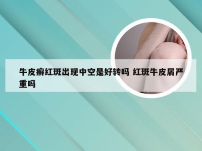 牛皮癣红斑出现中空是好转吗 红斑牛皮屑严重吗