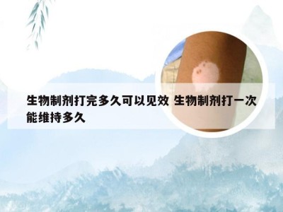 生物制剂打完多久可以见效 生物制剂打一次能维持多久