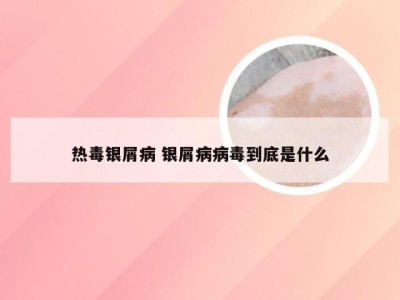 热毒银屑病 银屑病病毒到底是什么