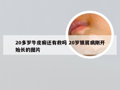 20多岁牛皮癣还有救吗 20岁银屑病刚开始长的图片