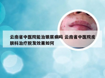 云南省中医院能治银屑病吗 云南省中医院皮肤科治疗脱发效果如何