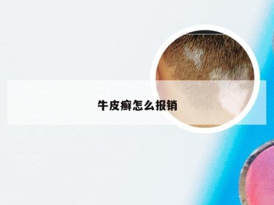 牛皮癣怎么报销