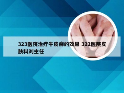 323医院治疗牛皮癣的效果 322医院皮肤科刘主任