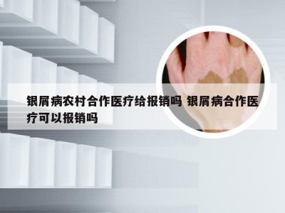 银屑病农村合作医疗给报销吗 银屑病合作医疗可以报销吗