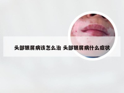 头部银屑病该怎么治 头部银屑病什么症状