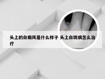 头上的白癜风是什么样子 头上白斑病怎么治疗