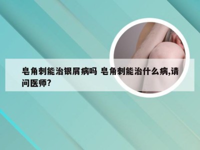 皂角刺能治银屑病吗 皂角刺能治什么病,请问医师?