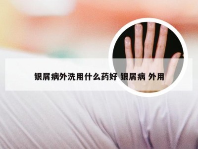 银屑病外洗用什么药好 银屑病 外用