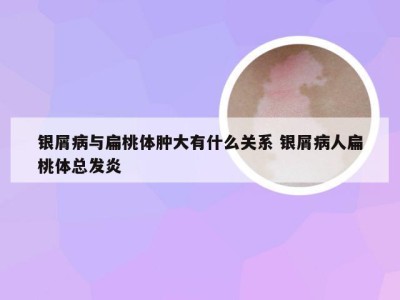 银屑病与扁桃体肿大有什么关系 银屑病人扁桃体总发炎