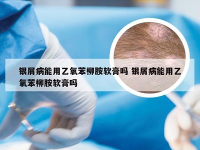 银屑病能用乙氧苯柳胺软膏吗 银屑病能用乙氧苯柳胺软膏吗