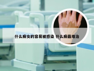 什么癣女的容易被感染 什么癣最难治