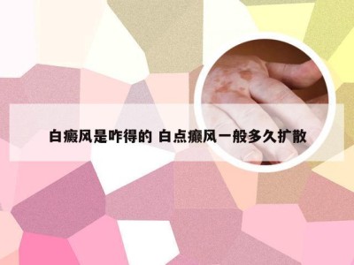 白癜风是咋得的 白点癫风一般多久扩散