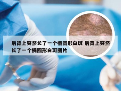 后背上突然长了一个椭圆形白斑 后背上突然长了一个椭圆形白斑图片