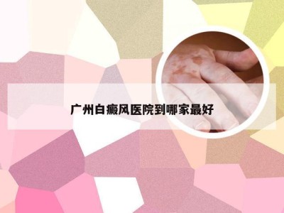 广州白癜风医院到哪家最好