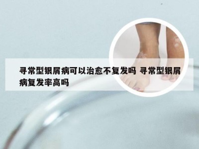 寻常型银屑病可以治愈不复发吗 寻常型银屑病复发率高吗