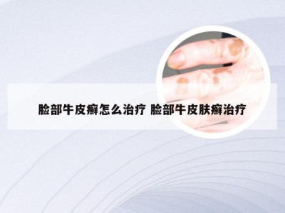 脸部牛皮癣怎么治疗 脸部牛皮肤癣治疗