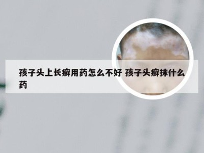 孩子头上长癣用药怎么不好 孩子头癣抹什么药