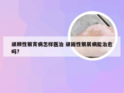 顽顾性银宵病怎样医治 顽固性银屑病能治愈吗?