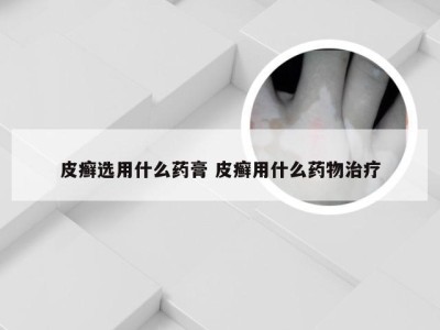 皮癣选用什么药膏 皮癣用什么药物治疗