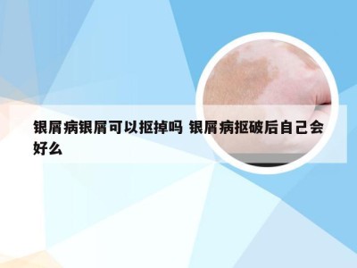 银屑病银屑可以抠掉吗 银屑病抠破后自己会好么