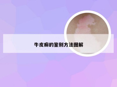 牛皮癣的鉴别方法图解