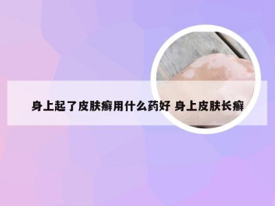 身上起了皮肤癣用什么药好 身上皮肤长癣