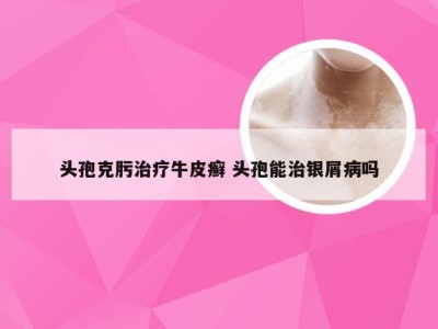 头孢克肟治疗牛皮癣 头孢能治银屑病吗