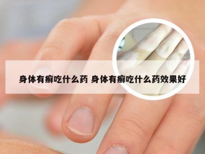 身体有癣吃什么药 身体有癣吃什么药效果好