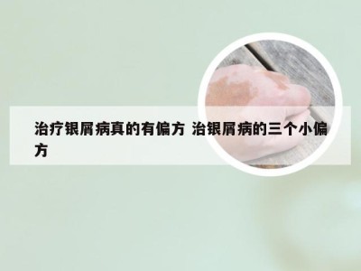 治疗银屑病真的有偏方 治银屑病的三个小偏方