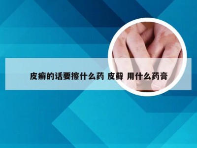 皮癣的话要擦什么药 皮藓 用什么药膏