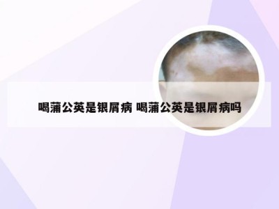 喝蒲公英是银屑病 喝蒲公英是银屑病吗