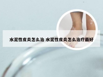 水泥性皮炎怎么治 水泥性皮炎怎么治疗最好