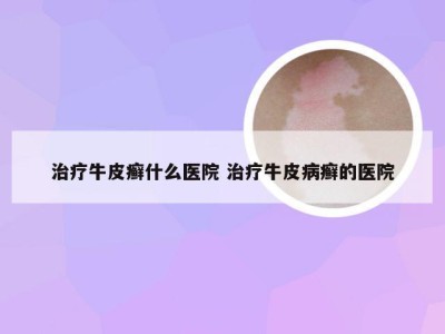 治疗牛皮癣什么医院 治疗牛皮病癣的医院