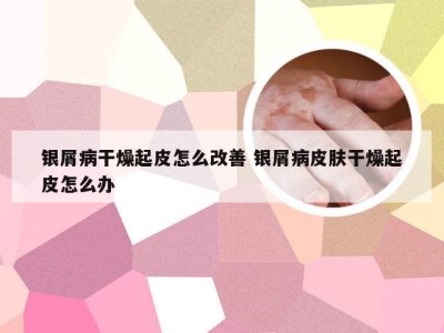 银屑病干燥起皮怎么改善 银屑病皮肤干燥起皮怎么办