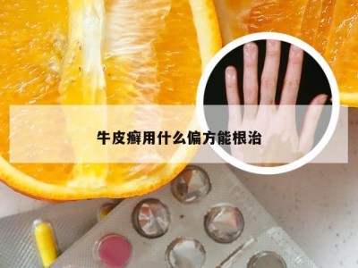 牛皮癣用什么偏方能根治