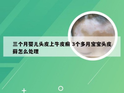 三个月婴儿头皮上牛皮癣 3个多月宝宝头皮藓怎么处理