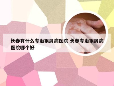 长春有什么专治银屑病医院 长春专治银屑病医院哪个好